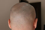 Scarless hair transplant in Dubai