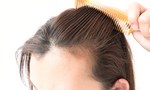 What to Know About Hair Loss Treatment For Women