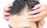 Topical Hair Loss Treatment