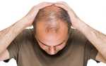 Types of Hair Transplantation Methods