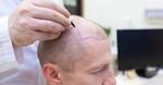 Hair Transplant Straight Forward And Affordable