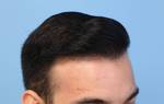 Hair Transplantation