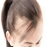Female Hair Transplant