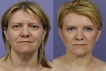 Facelift-Treatment