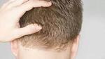 FUE Hair Transplant in Dubai