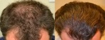cheap and best hair transplant banner