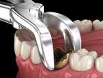 Wisdom Tooth Extraction in Dubai