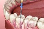  Root Canal Treatment in Dubai