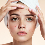 pimples treatment in dubai