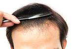 hair restoration in dubai 