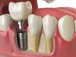 Loose Dental Implant in Dubai