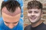 Hair Transplant  for Young adults in Dubai 