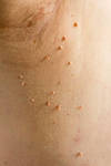 Skin Wart Removal Cost In Dubai