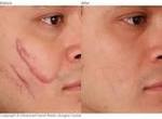 Facial Scar Revision in Dubai