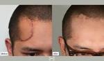 Surgical Scar Revision in Dubai