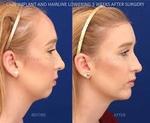 Chin Reduction in Dubai