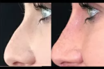 Rhinoplasty in Dubai