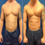 Vaser 4d Liposuction in Dubai