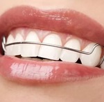 aneesha khan Dental Retainers