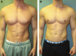 Gynecomastia Surgery