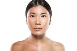 Gluathione Injections