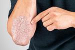 Psoriasis Treatment